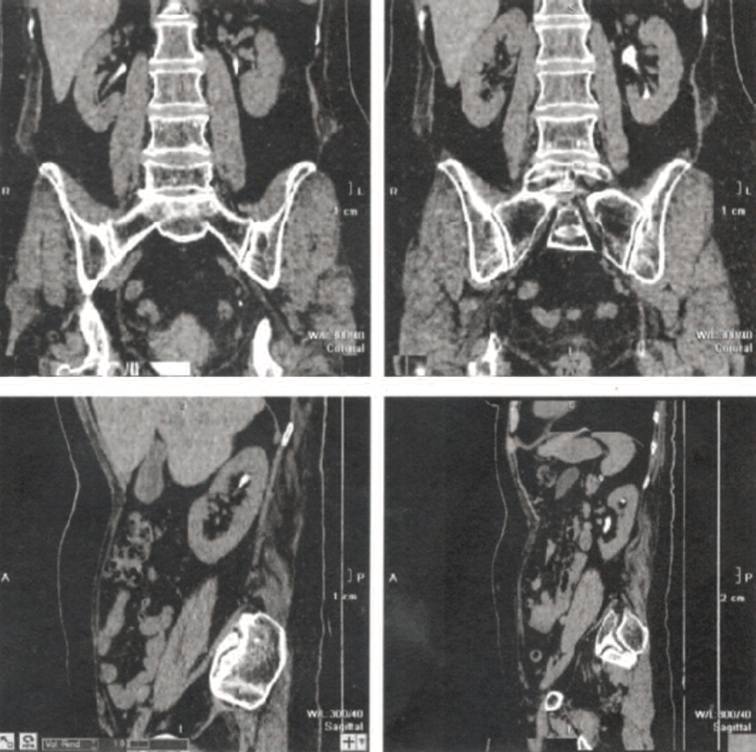 Рентгеновская компьютерная томография почек