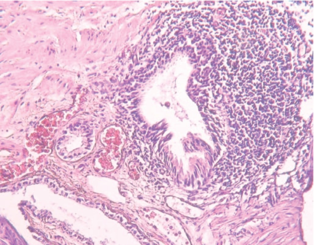 Ткань простаты. Стромальная гиперплазия предстательной железы. Лимфофолликулярная инфильтрация 12 ПК.. Лимфоплазмоцитарный склерозирующий панкреатит. Лимфоплазмоцитарный ринит цитология.