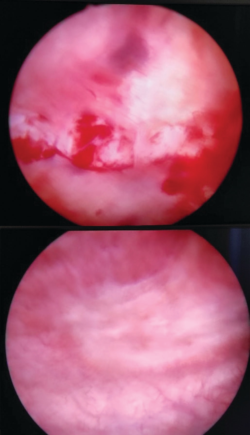 Рис. 2. Цистоскопическая картина больной У. при контрольном обследовании через 1 месяц после первой операции