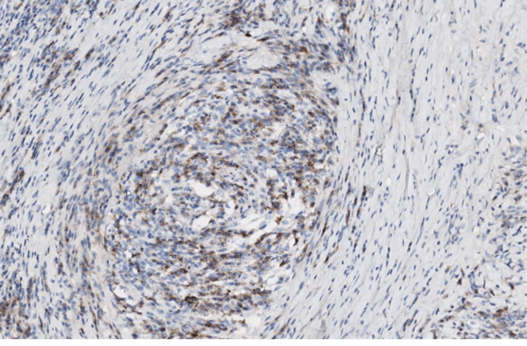 Рис. 10. Перифлебит. Реакция с антителами к CD138 позитивная в цитоплазме плазматических клеток. x200
