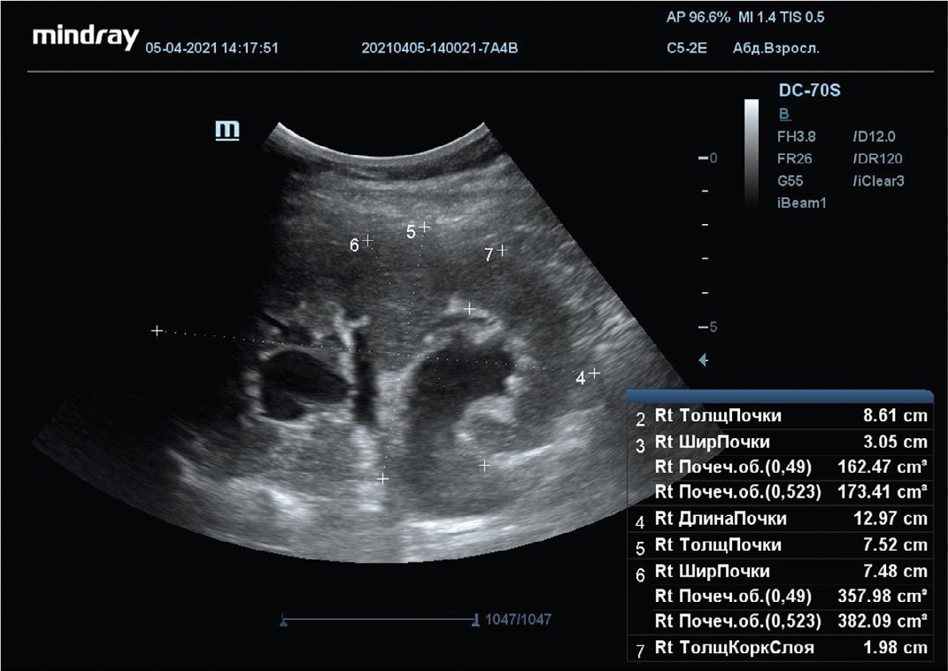  Уретеропиелокаликоэктазия справа. Беременность 32 недели