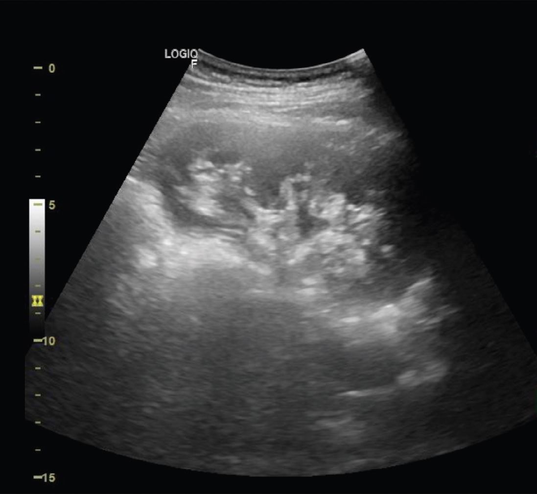 Ультразвуковая картина правой почки через 3 недели после родов