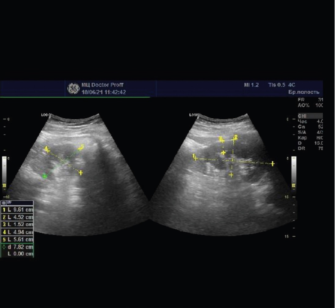  Ultrasound. Rigt kidney, 3 weeks after childbirth