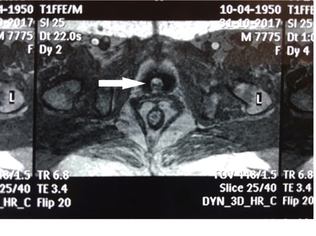 МРТ малого таза, поперечный срез. Стрелкой показана опухоль уретры