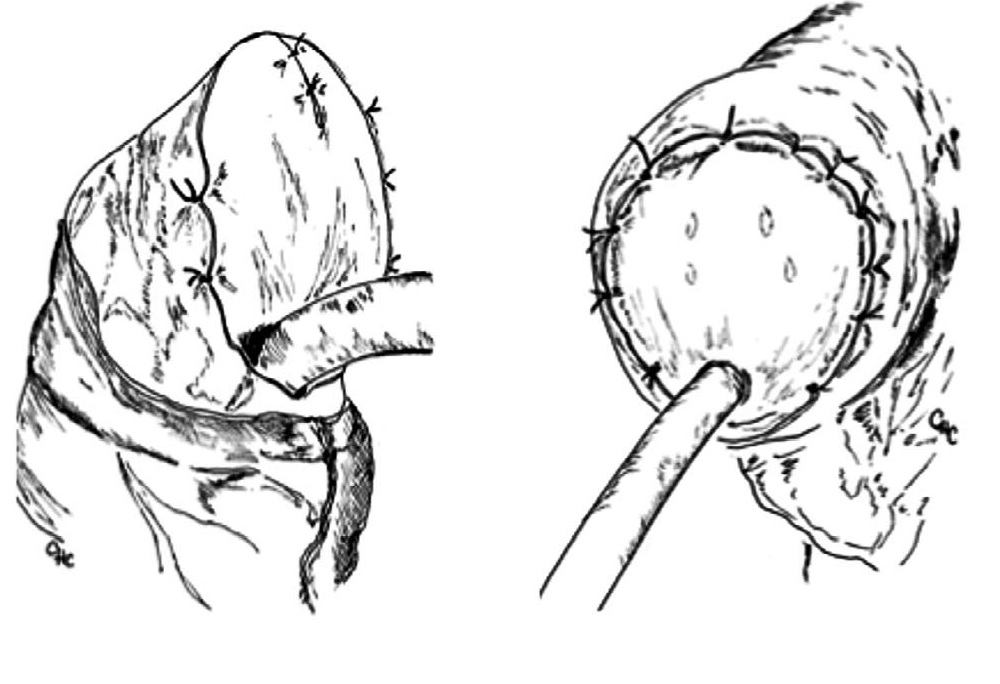 Scheme of glanuloplasty with a urethral flap by J.J. Belinky et a