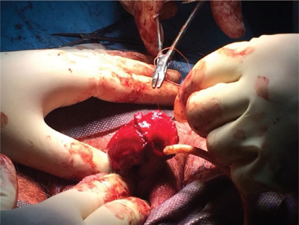 Формирование неогланса из уретрального лоскута