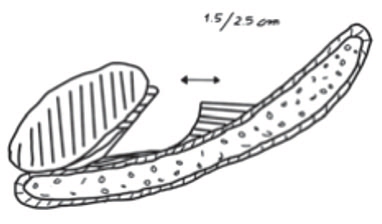 Схематичное изображение лигаментотомии – рассечение подвешивающей связки между половым членом и лонной костью, позволяющее несколько переместить вперед ствол полового члена. По Э. Аустони и др. [13]
