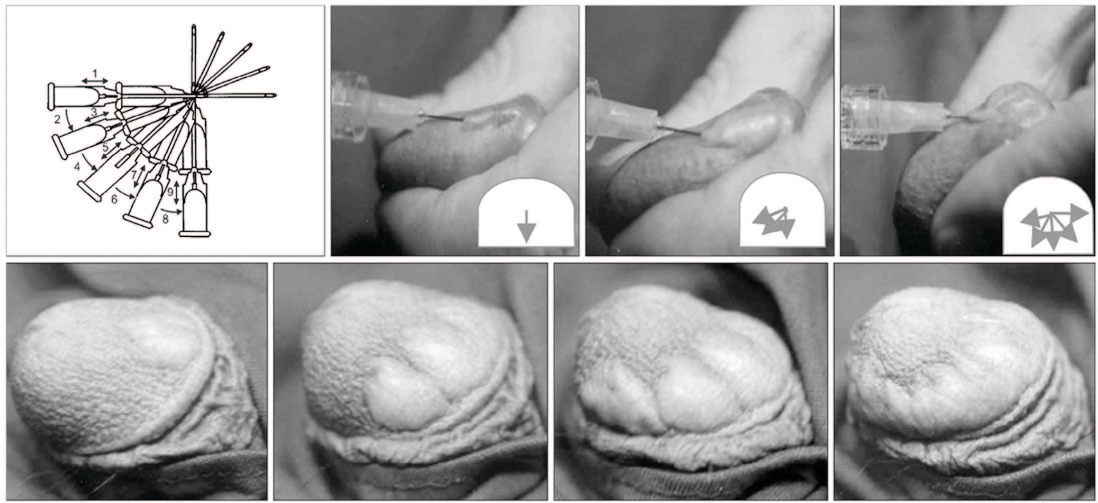Инъекция биополимера гиалуроновой кислоты в головку полового члена