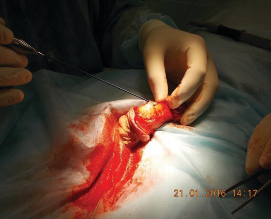 Селективная криоаблация дорсального нерва полового члена. Фото представлено авторами статьи