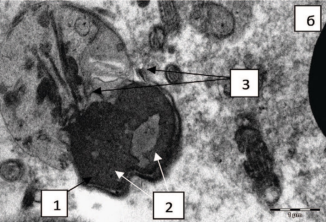Abnormal forms of spermatozoa