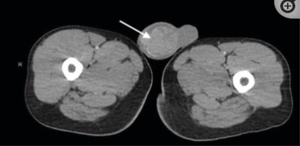 КТ брюшной полости и таза с контрастированием: неоднородное увеличение правого яичка, его придатка, семенного пузырька, увеличение мезентериальных лимфоузлов