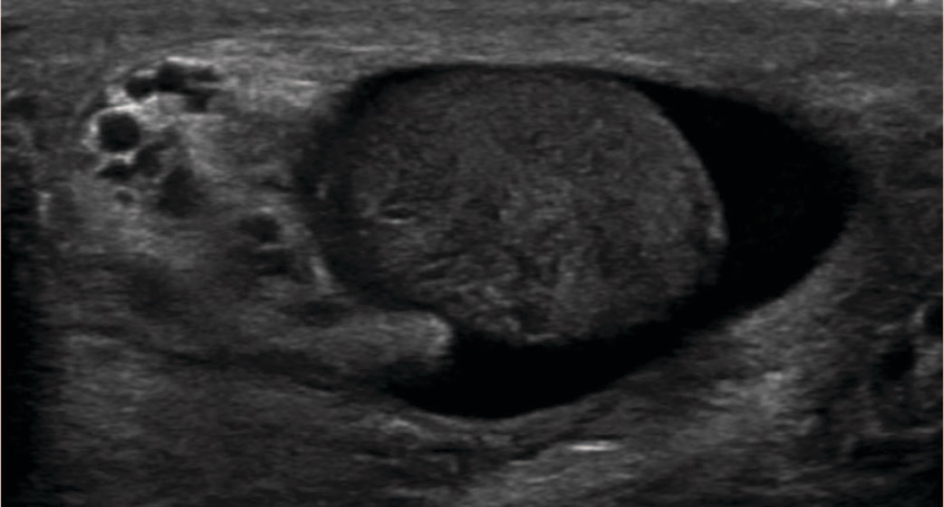 УЗИ яичек – увеличенный неоднородный гиперемированный правый придаток с участком гипоэхогенности в хвосте – признак формирующегося абсцесс