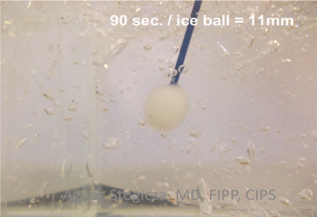 «Ice ball» на дистальной части криозонда