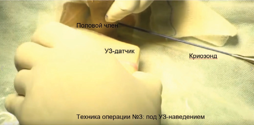 Селективная малоинвазивная криоаблация дорсального нерва под УЗ-наведение