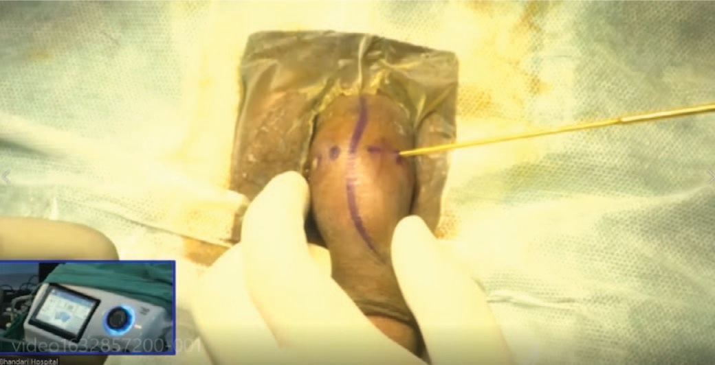 Селективная малоинвазивная криоаблация дорсального нерва полового члена с использованием анатомических ориентиров