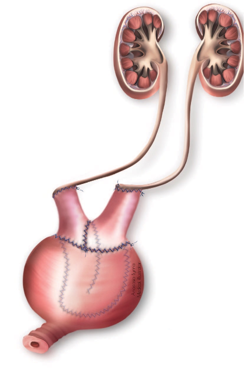 Схема расширяющей кишечной пластики мочевого пузыря с раздельной реимплантацией мочеточников в два из нетубуляризированных конца кишечного сегмента