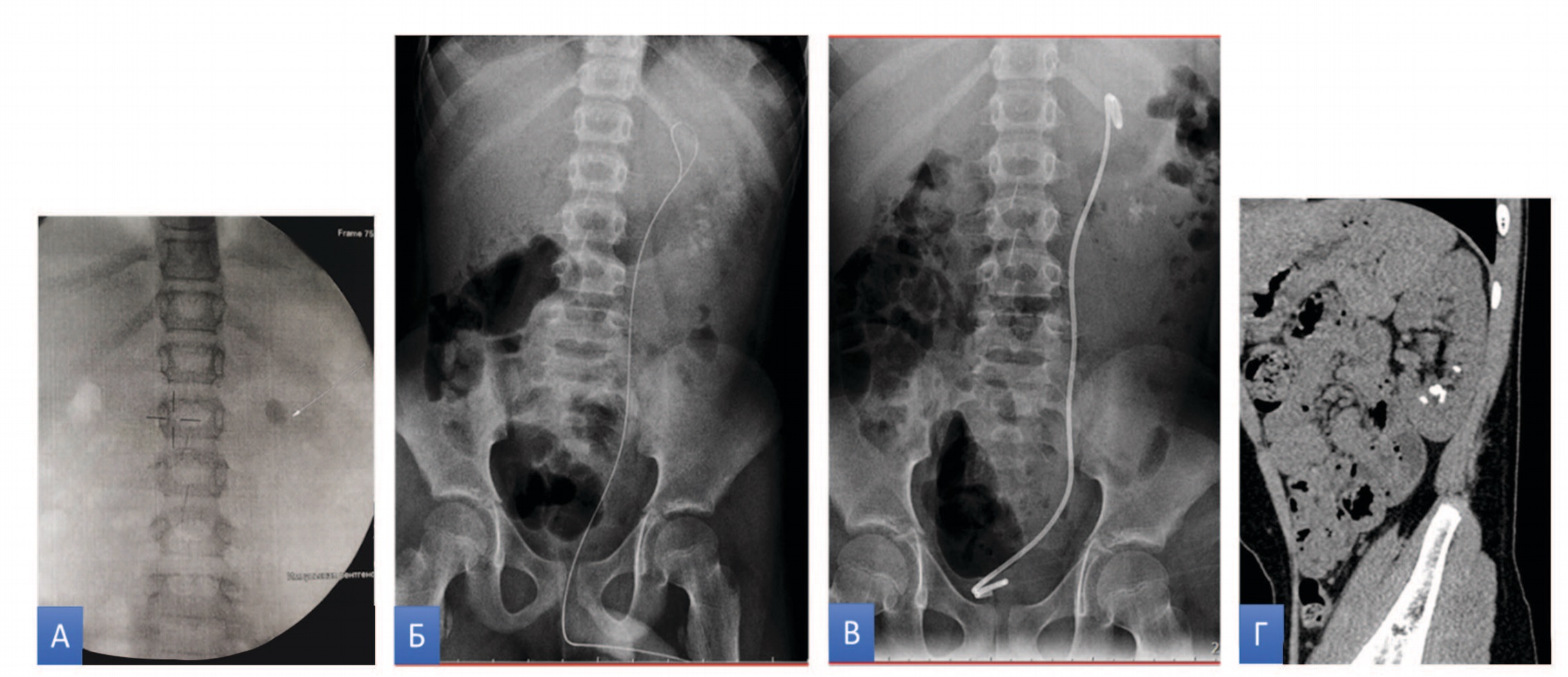 Клинические данные пациента М 10л. (слева направо): А - рентгеновский снимок до ДУВЛ, Б - рентгеновский снимок со струной проводником, В - рентгеновский снимок после удаления каменной дорожки и установки внутреннего стента слева, Г - КТ через 1 мес после ДУВЛ