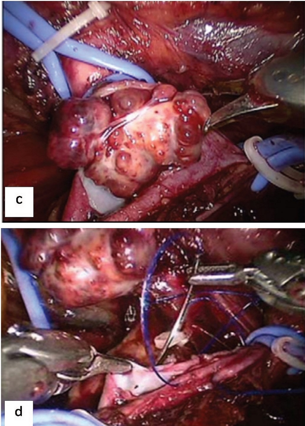 Stages of robot-assisted IVC thrombectomy: a – tourniquet placement, b – venotomy, c – IVC thrombectomy, d – suturing of the venotomy