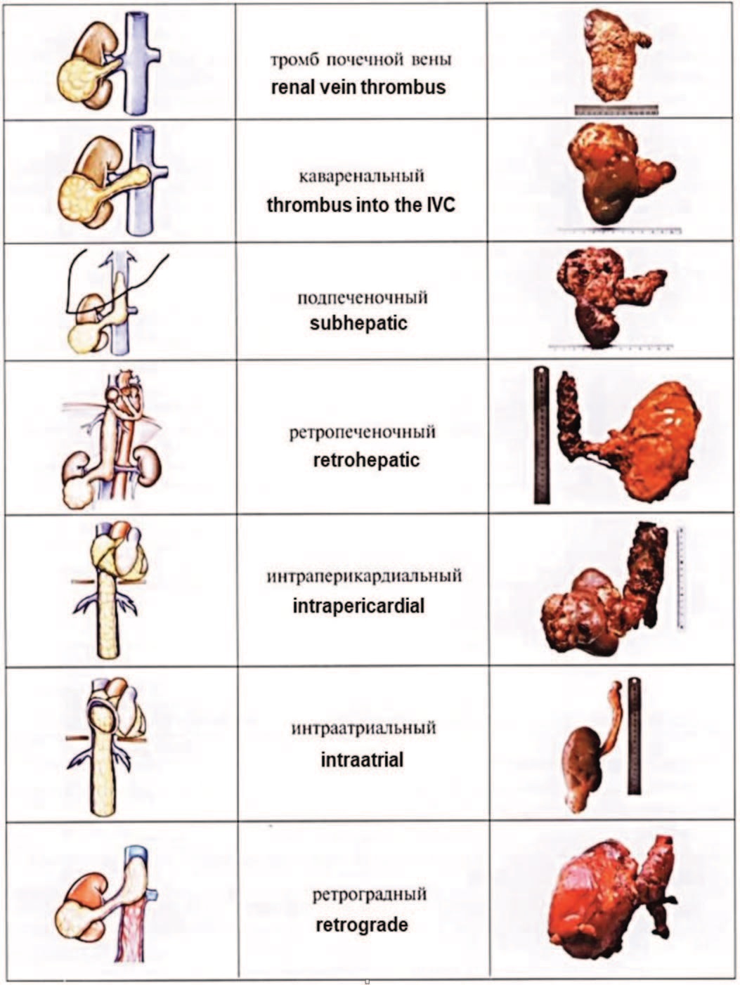  Классификация опухолевых тромбов по А.С. Переверзеву 