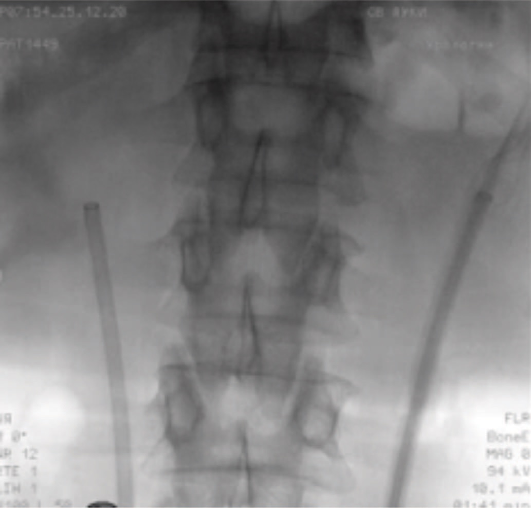 Рентгенологическая картина во время установки мочеточниковых кожухов