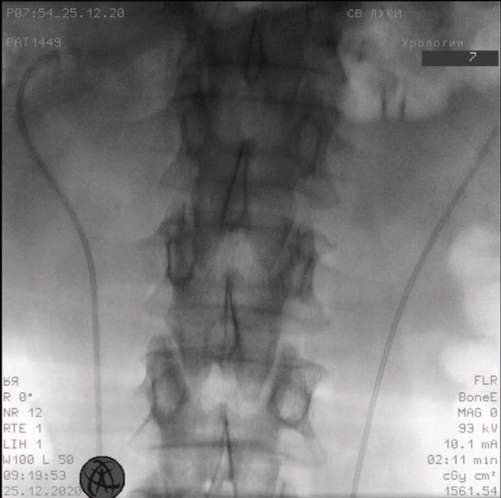 Катетеризация верхних мочевыводящих путей: A – рентгеновская картина