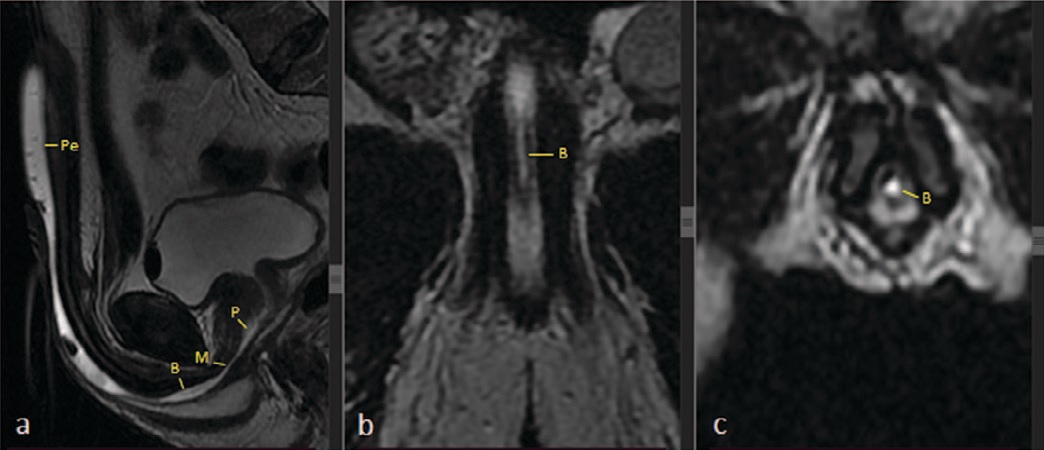 Рис. 2. Визуализация мужской уретры при МРТ: Т2-взвешенное сагиттальное изображение
