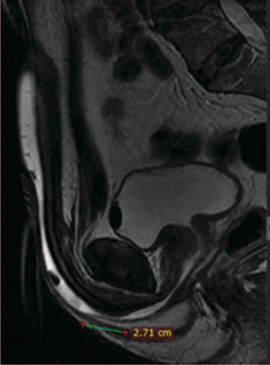 Рис. 3. Стриктура бульбозной уретры длиной 2,71 см при сагиттальном Т2-взвешенном изображении МРТ. Собственные данные