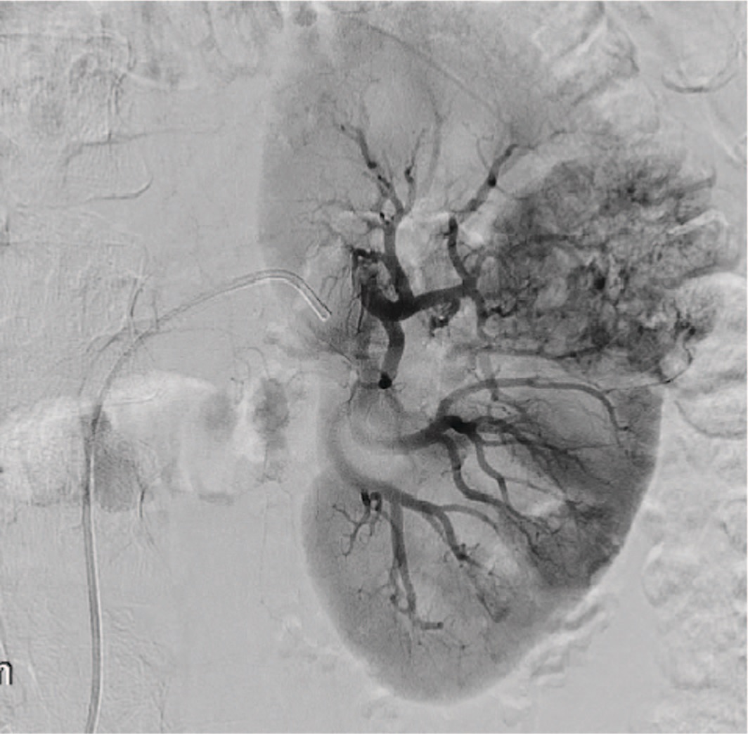 Рис. 1. Селективная ангиограмма почечной артерии с локализованным злокачественным новообразованием почки