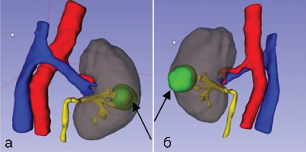 3D – реконструкция расположения опухоли почек и почечных сосудов