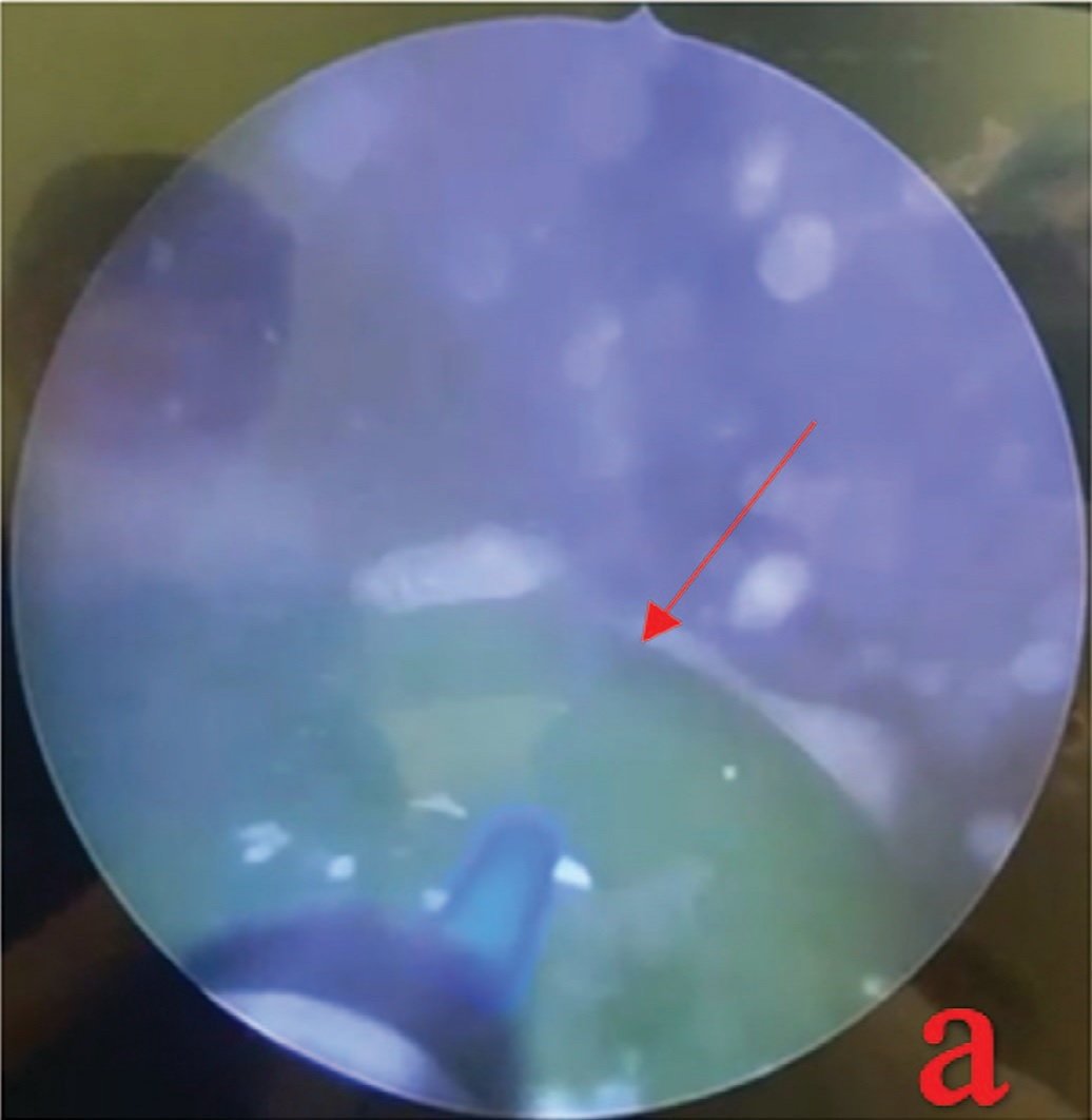 А – на этапе цистолитотрипсии обнаружено инкрустированное инородное тело (восковая свечка)