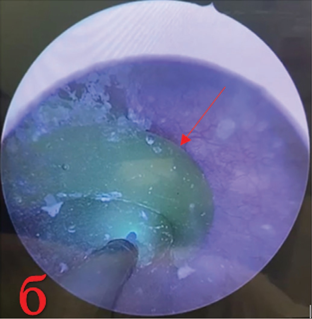  Б – в полости мочевого пузыря закрученная восковая свечка (после этапа лазерной цистолитотрипсии)