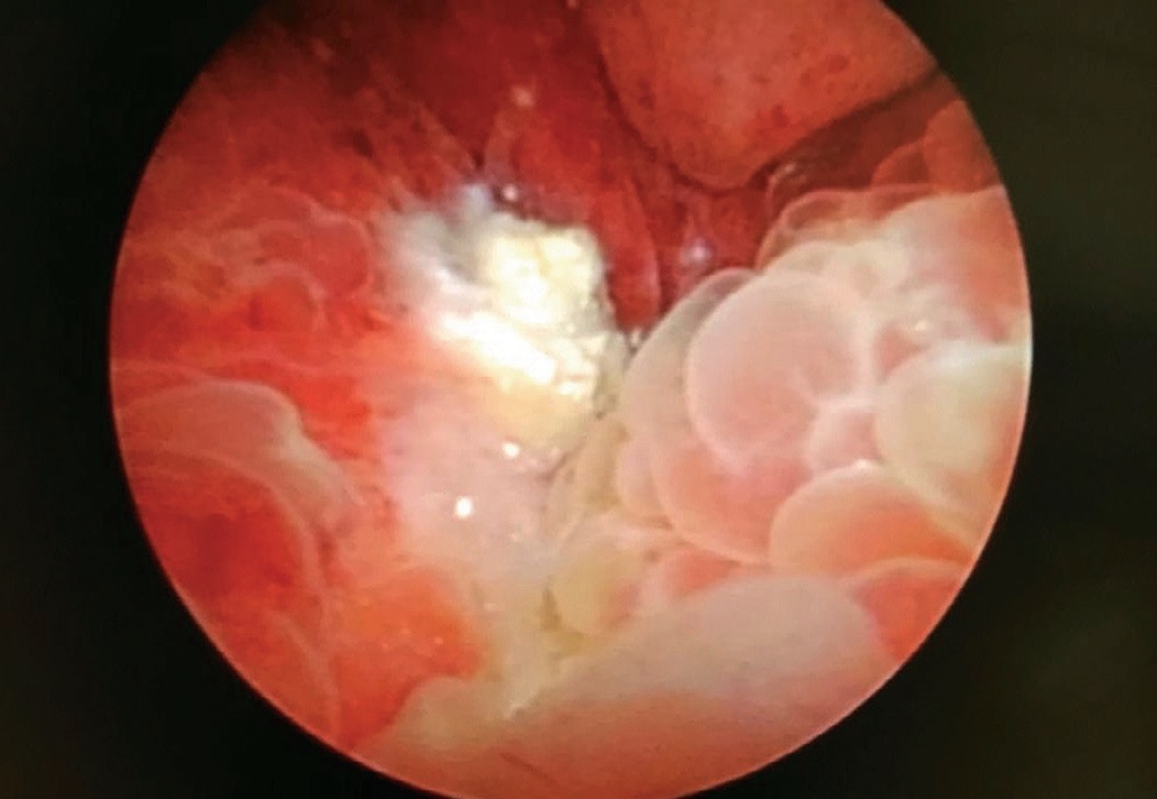 Цистоскопическое изображение постлучевого пузырно-влагалищного свища. Границы свища обнаружить невозможно ввиду массивного фиброза, воспаления и отека окружающих тканей