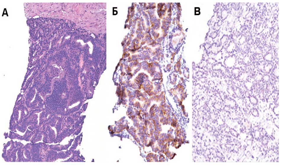 Больной М. НЭД РПЖ (гематоксилин и эозин) (А), тот же участок – иммуногисто-химическое исследованием (синаптофизин) (Б), хромогранин (В)