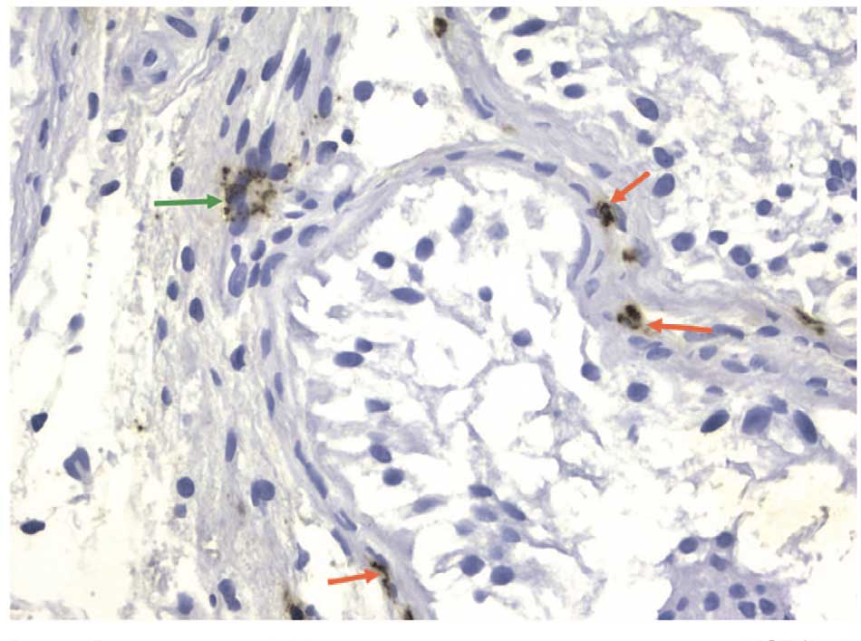 Яичко пациента A. Иммуногистохимическая окраска с анти-MCT (AntiMast Cell Tryptase). Увеличение ×40. Зеленая стрелка указывает на тучную дегранулированную триптаза-позитивную тучную клетку, которая находится в интерстиции яичка. Красные стрелки указывают на триптазопозитивные тучные клетки, которые находятся перитубулярно