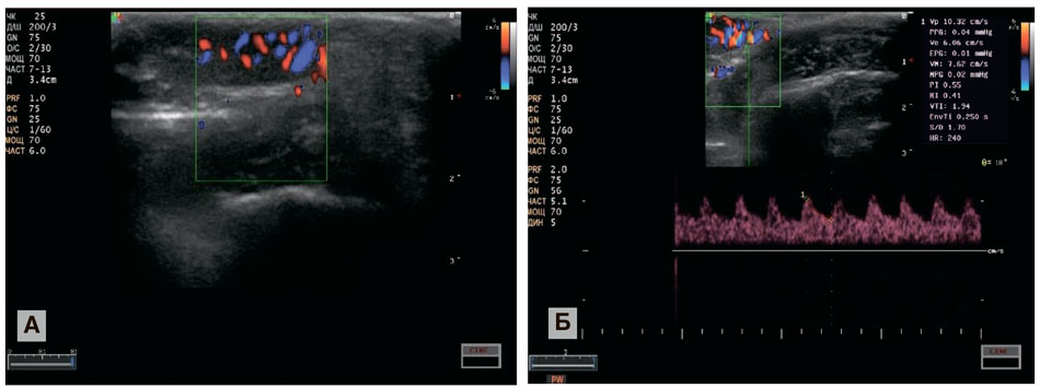 Эхограмма (а) и допплерограмма (б) на 30-сутки. При мануальной компрессии брюшной полости имеется рефлюкс по семенным венам кролика
