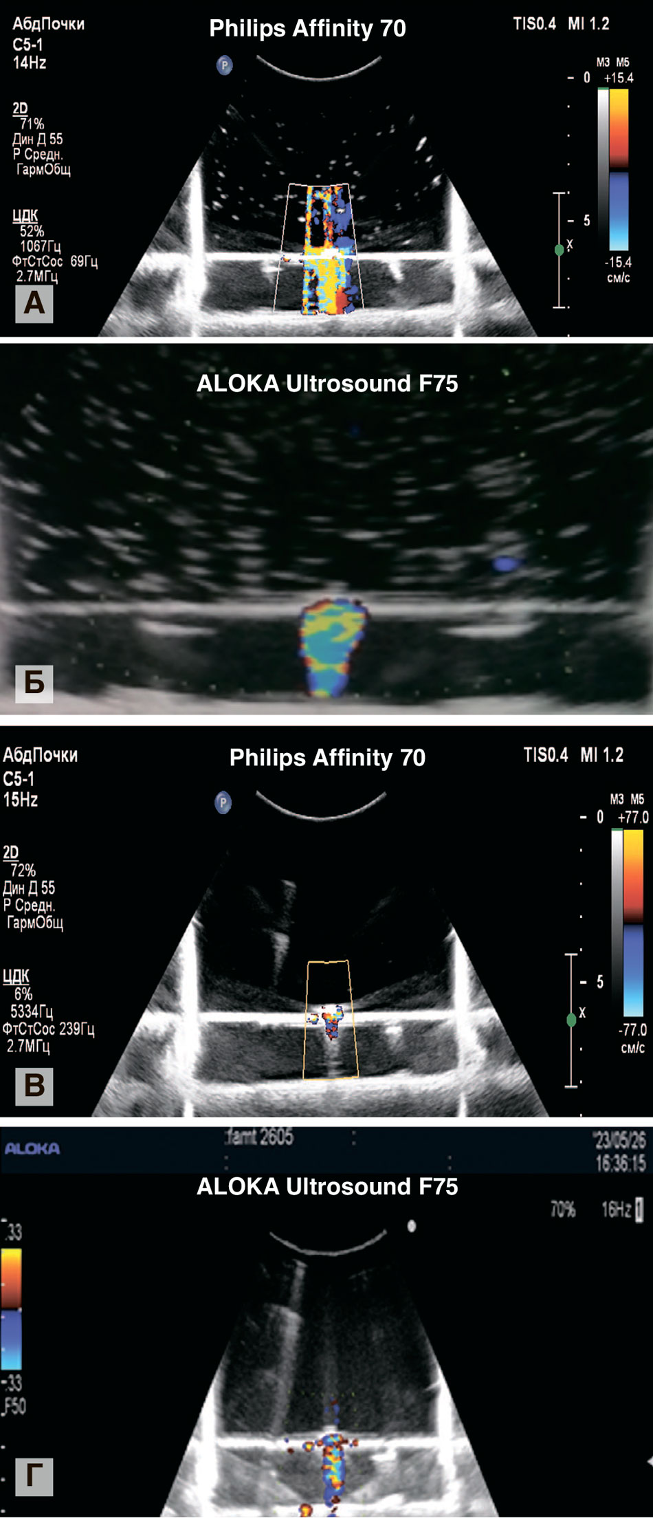 Артефакт мерцания дигидрата сульфата кальция, полученный на УЗ-аппаратах Philips Affinity 70 (А, В), ALOKA Ultrosound F75 (Б, Г): А, Б – до настроек режима допплеровского картирования, В, Г – после настроек
