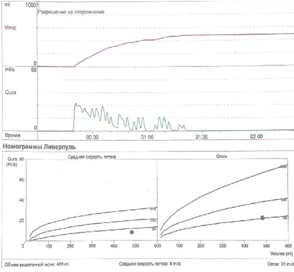 Урофлоуметрия до оперативного лечения