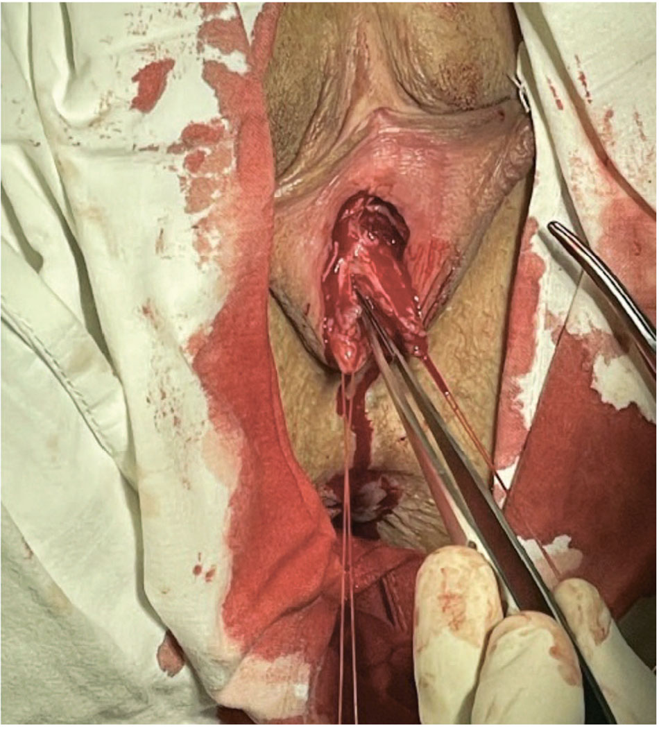 Выделение уретры