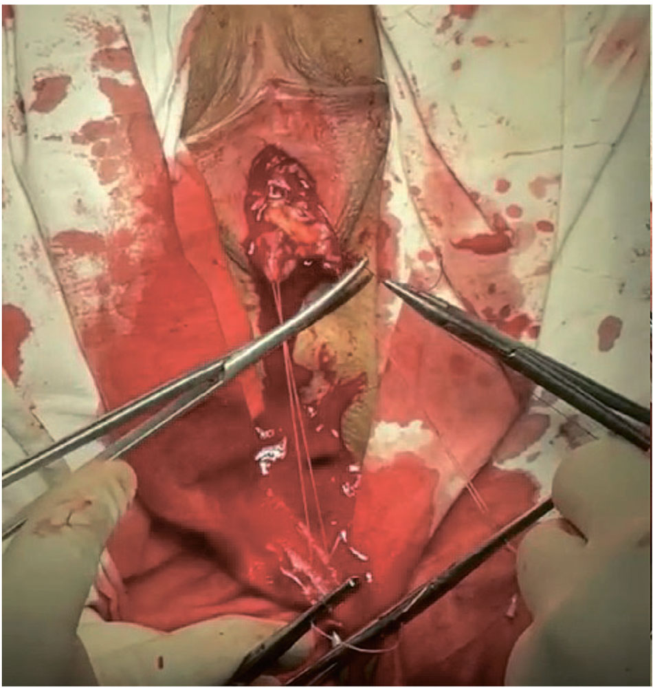 Фиксация трансплантата