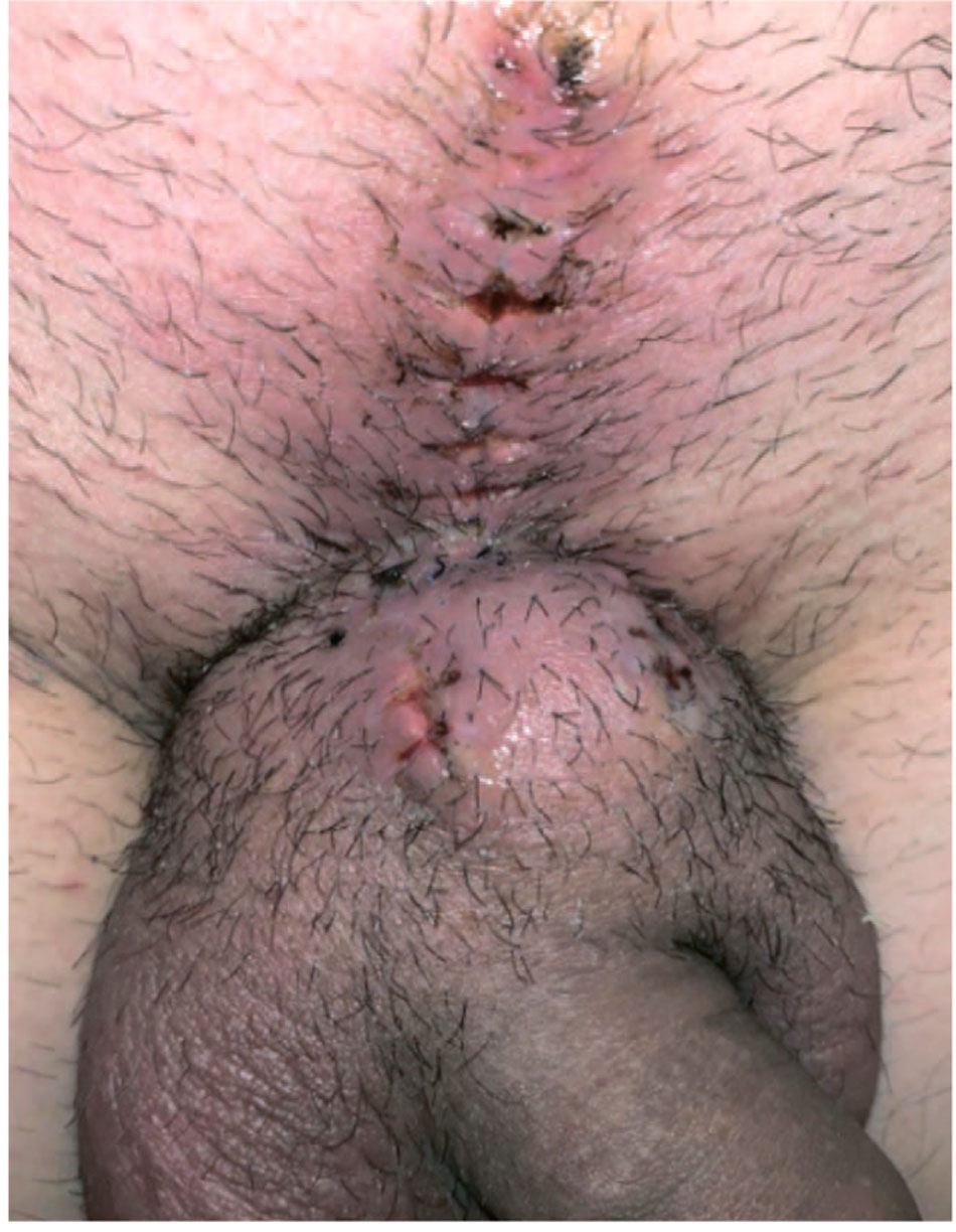 Лигаментотомия с применением V-Y образной кожной пластики