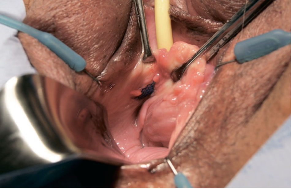 Проведение субуретральной петли через свод влагалища