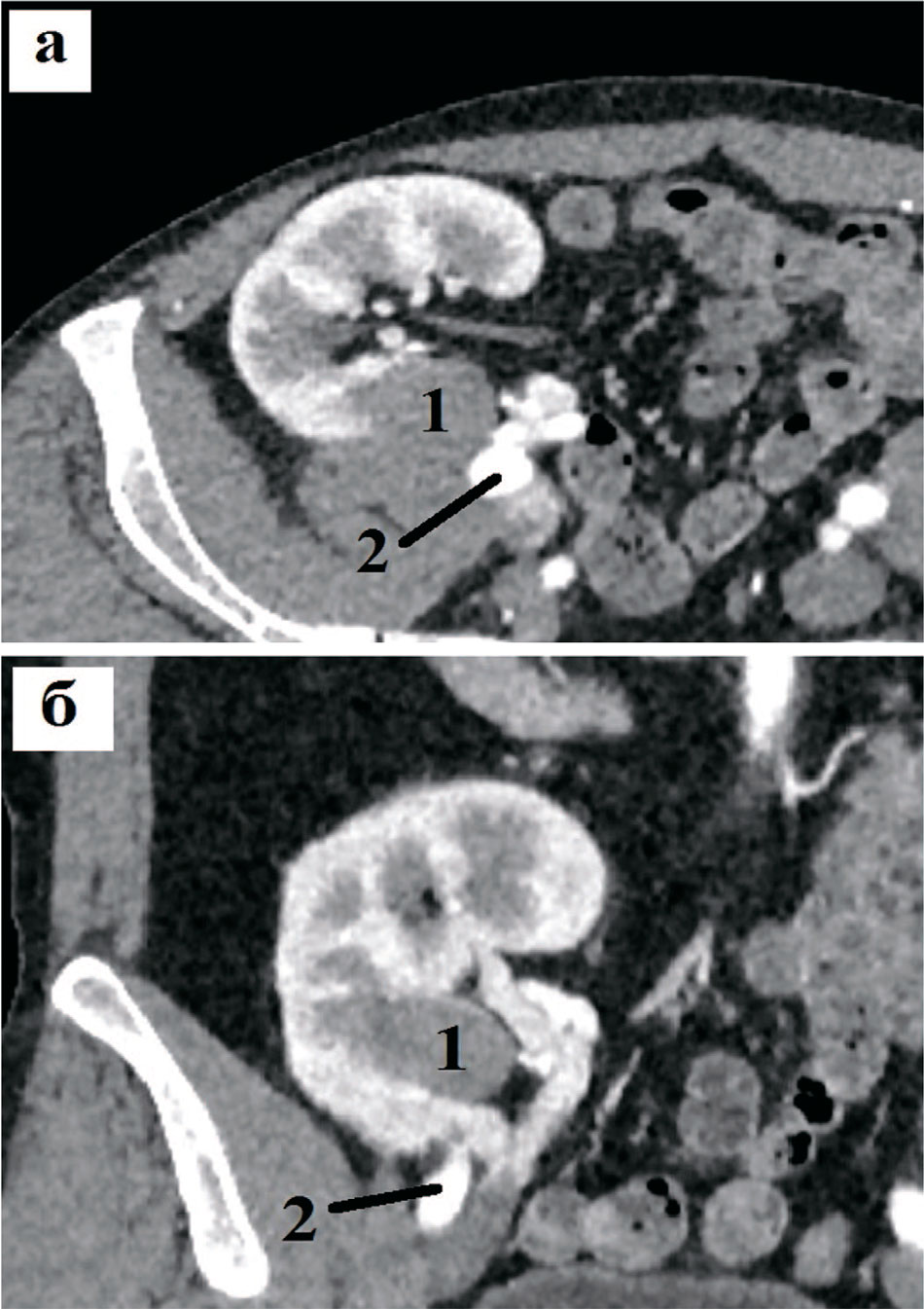 Компьютерные томограммы пациента с образованием трансплантированной почки