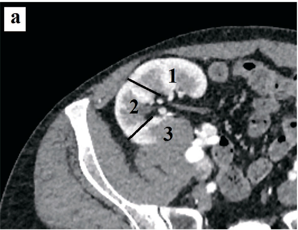 Компьютерные томограммы пациента с образованием трансплантированной почки
