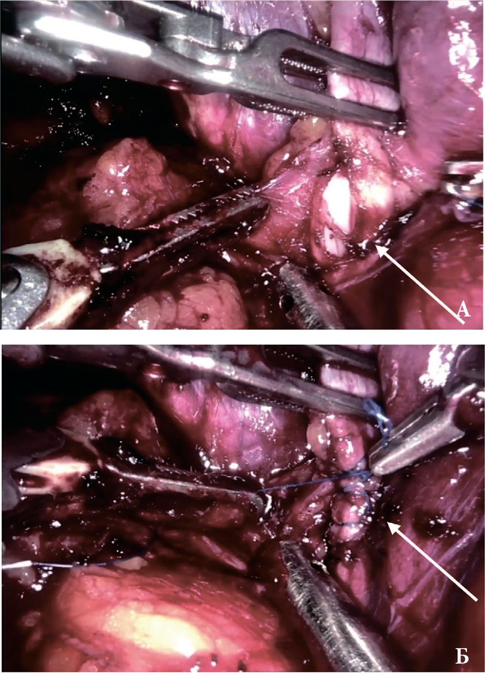 Эндоскопическая картина травмы правой наружной подвздошной вены во время РПЭ