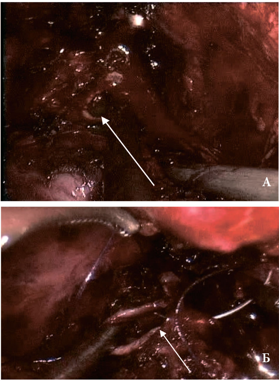 Перфорация прямой кишки в ходе РПЭ