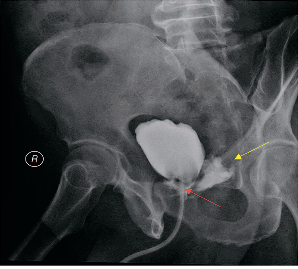 Экстравазация контрастного вещества (указан желтой стрелкой) – признак несостоятельности цистоуретроанастомоза