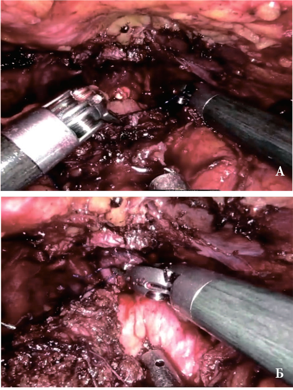 Формирование узловых швов уретроцистоанастомоза