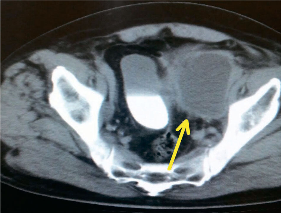 КТ-картина лимфоцеле, сформировавшегося слева, с признаками воспаления