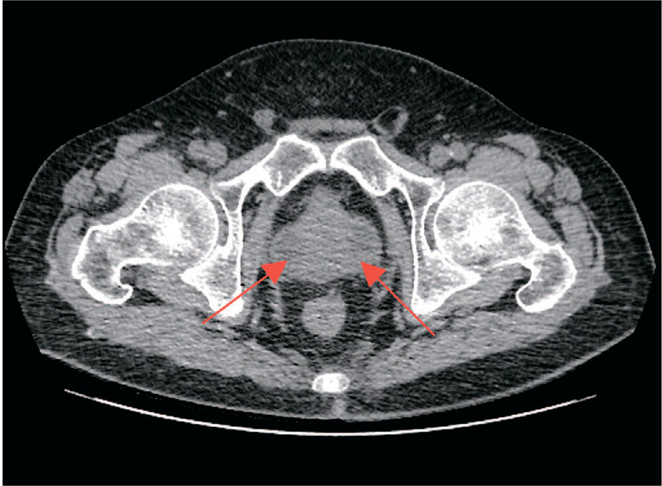 Нативная компьютерная томография почек и мочевыводящих путей