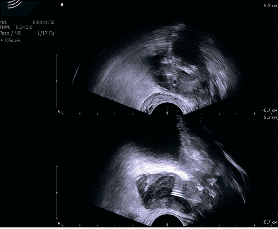 Ультразвуковая картина пункционного дренирования абсцессов предстательной железы